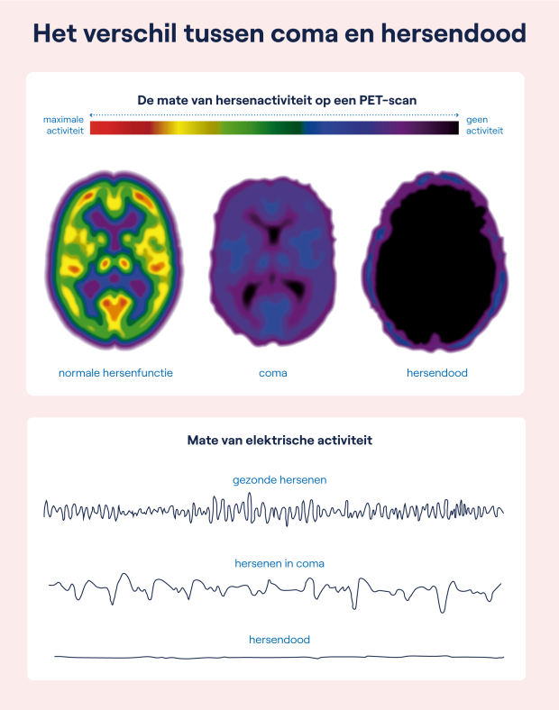 Op dit plaatje zie je drie EEG-afbeelden die het verschil aantonen in de hersenactiviteit van een gezond persoon, van iemand in coma en van iemand die hersendood is